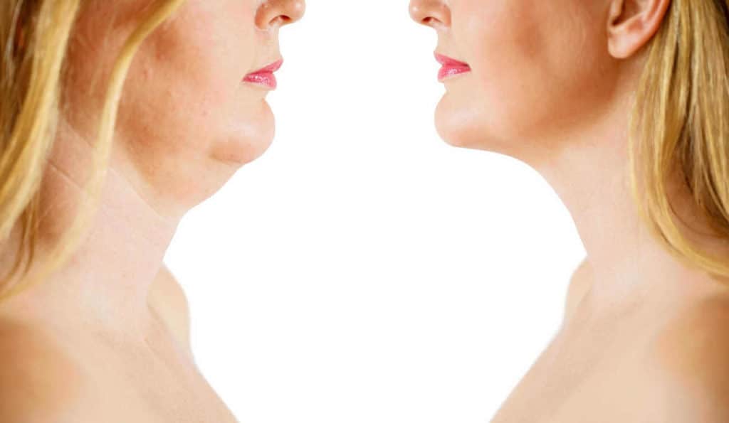 Double Chin treatment St Albans before and after results