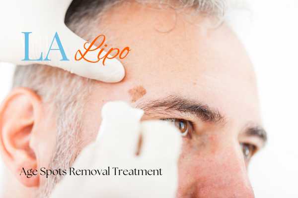 What Are the Most Effective Treatments for Age Spots St Albans?