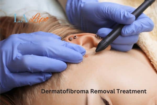 Dermatofibroma Removal Treatment St Albans
