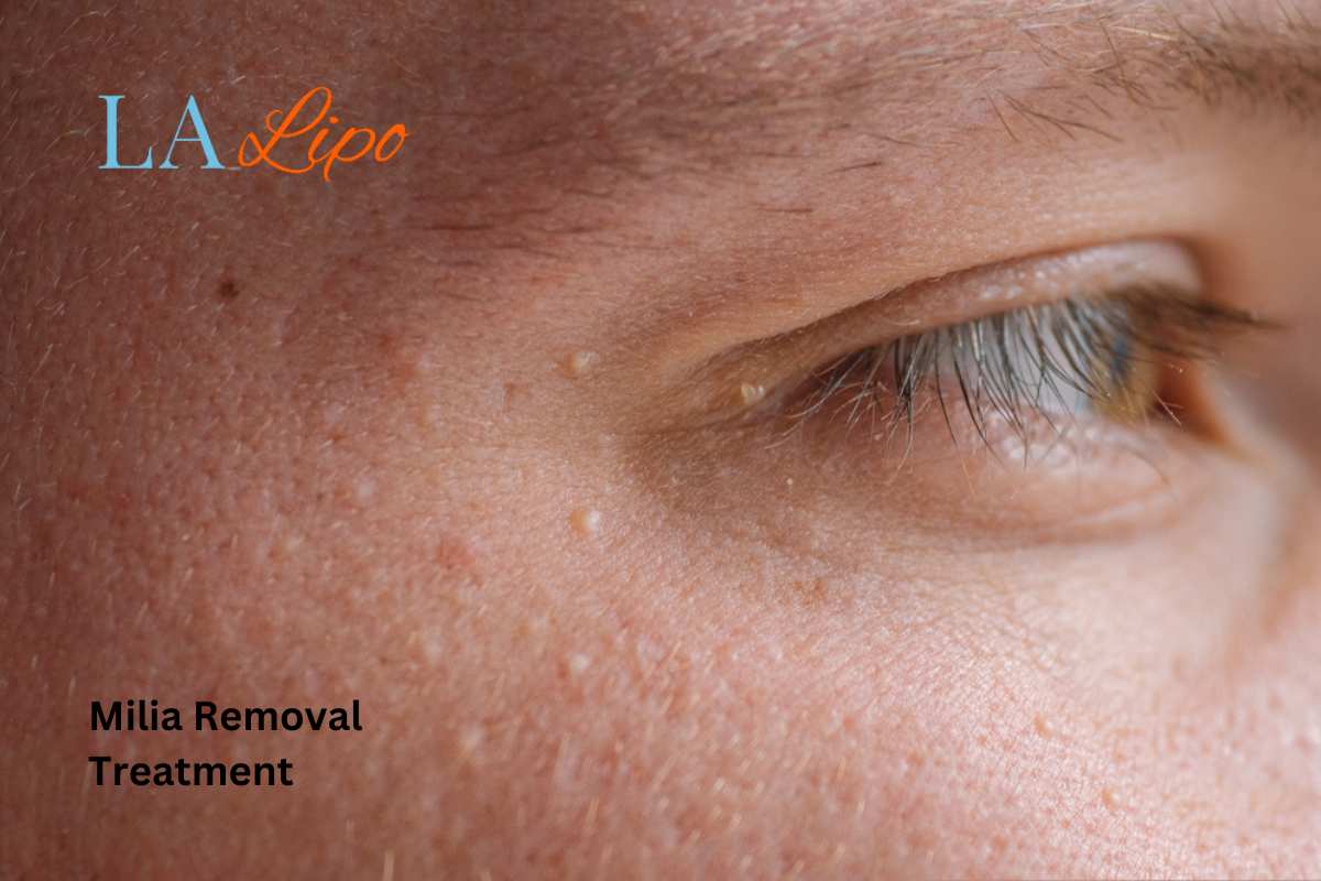 Cryopen Milia Removal: Is It the Easiest and Safest Option St Albans?
