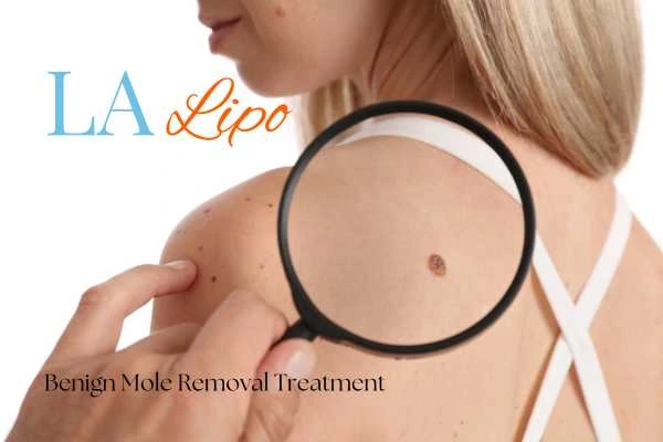 Why getting moles removed St Albans can boost your confidence!