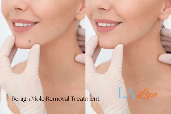 Woman's before and after results of being moles removal treatment St Albans