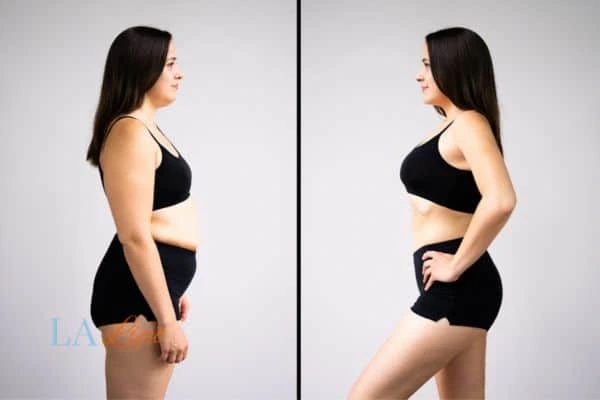 image of woman before and after results of LA-EMS Body Sculpting St Albans to help treat Diastasis recti