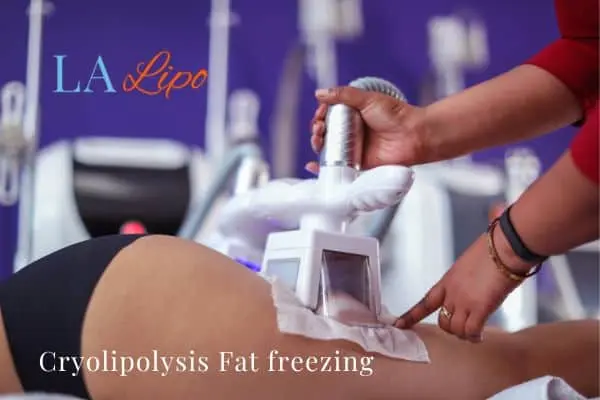 women getting fat freezing St Albans