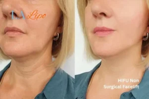 hi-fu for wrinkles St Albans before and after results