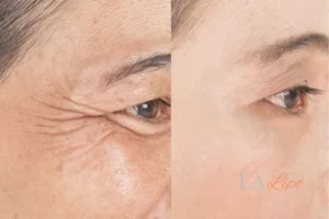 Before and after results of woman - HI-fu wrinkles reduction treatment St Albans
