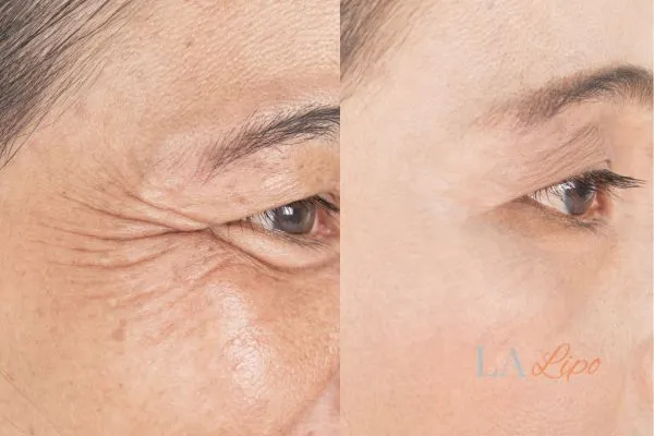 Before and after results of woman - HI-fu wrinkles reduction treatment St Albans