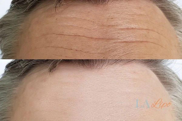 results of HIFU St Albans on mans forehead to help reduce lines and wrinkles