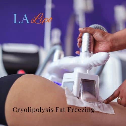 fat freezing - Cryolipolysis St Albans
