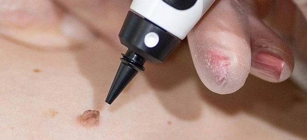 skin tag removal using cryopen St Albans