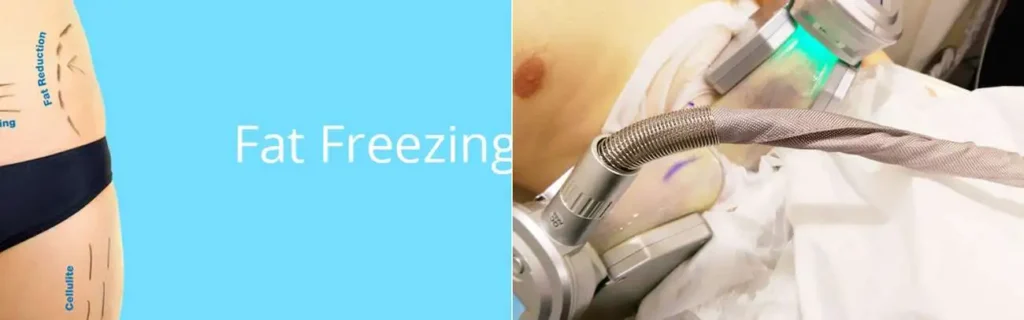 Fat freezing St Albans on multiple areas of the body