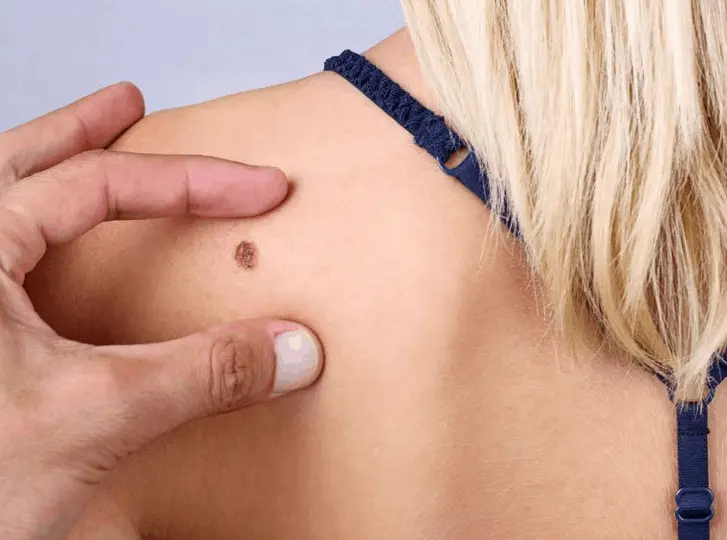 woman having mole removal St Albans consultation before treatment.