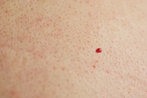 close up of a cherry angioma St Albans