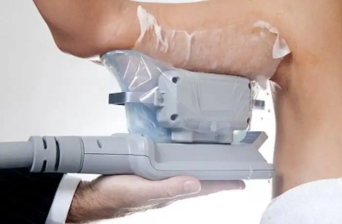 Picture of fat freezing St Albans on the upper arms.