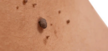 image of a skin tag St Albans