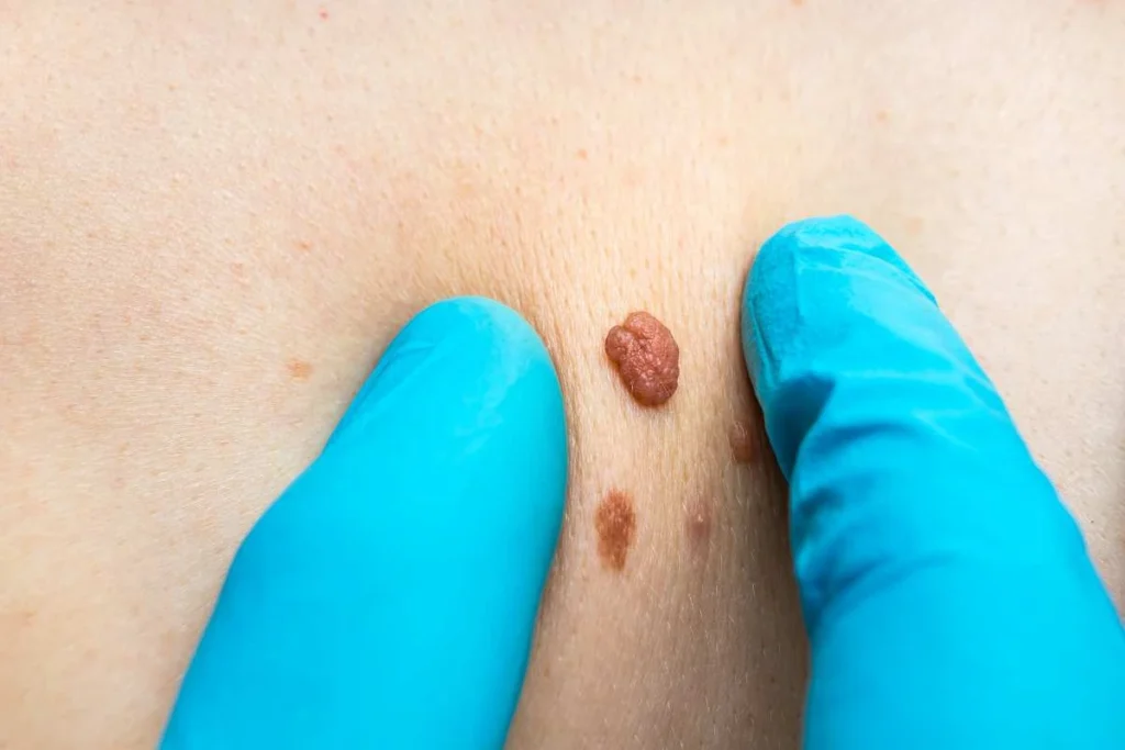 Consultant examining a skin tag St Albans