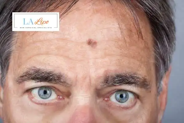 Solar Lentigo Removal St Albans image of man with mark on his forehead