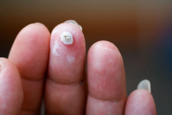 wart on person finger - cryotherapy to treat from LA LIPO St Albans