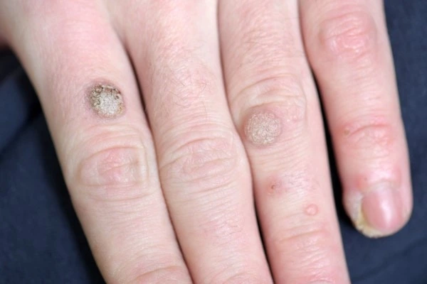 photo of warts on person hand - see wart removal St Albans from LA LIPO