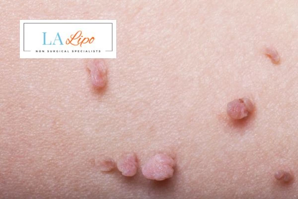 Does cryopen skin tag removal St Albans hurt? Find out now call our team today!