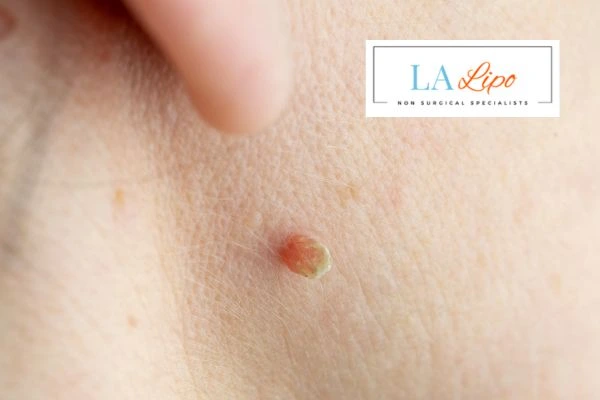 Book skin tag removal St Albans today speak to our team now!