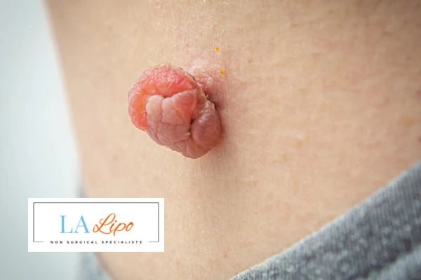 Interested in skin tag removal St Albans? Concerned about the pain? Find out more today!