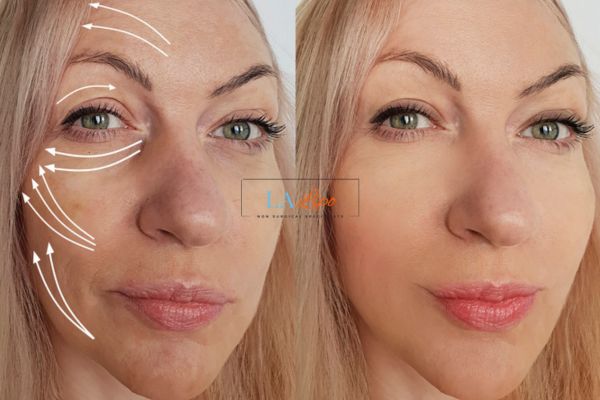 Morpheus 8 results St Albans face lift.