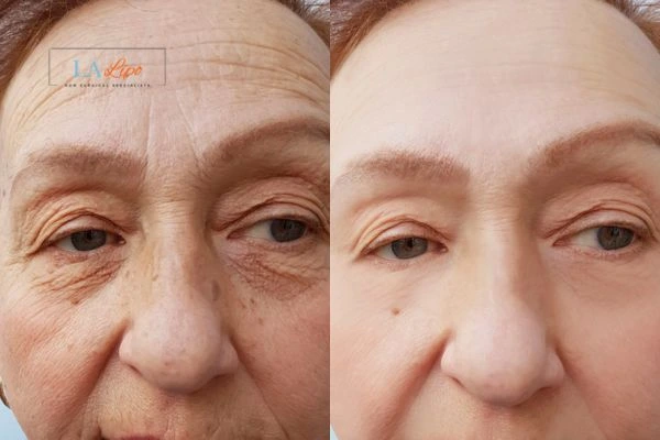 The powerful benefits of Morpheus8 Treatment St Albans - Call Our team today!