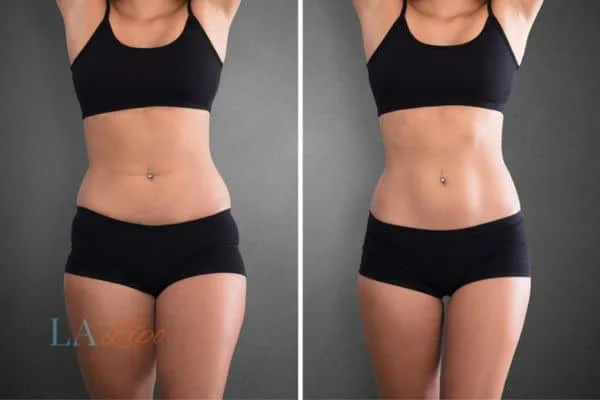 before and after results of non-surgical treatment to help a woman's body image and mental health St Albans