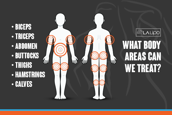 Diagram to show areas you can have LA-EMS Body Sculpting Treatment St Albans