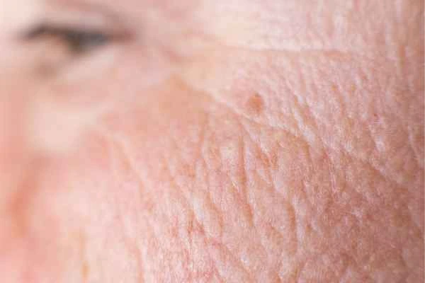 close up picture of a woman's face showing an age spot St Albans