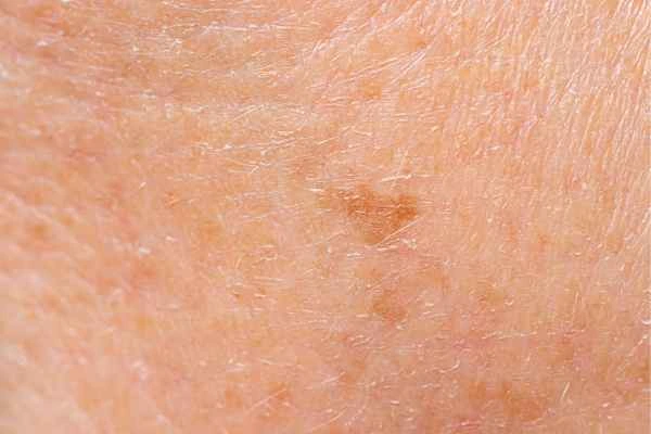 close up picture of age spots St Albans