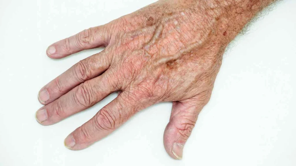 Male hand showing age spot St Albans