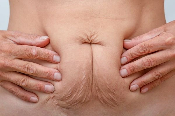 Image of a woman's stomach with loose skin - example of skin tightening St Albans options