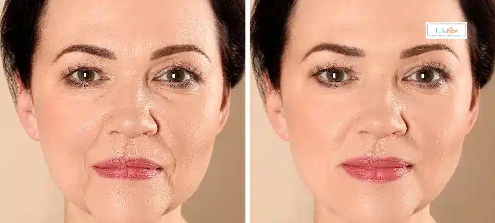 How Long Does It Take to See Results and How Long Do They Last St Albans?
