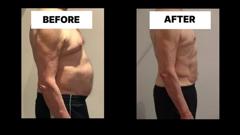 What Symptoms Can Diastasis Recti Cause in Men? Weak Core, Back Pain and Poor Posture St Albans